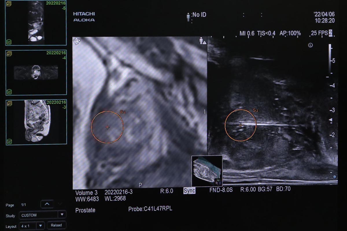 前立腺生検の画像